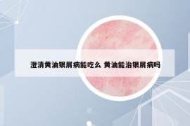 澄清黄油银屑病能吃么 黄油能治银屑病吗