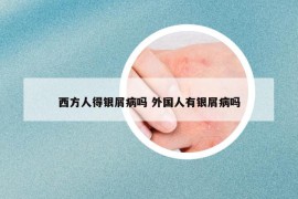 西方人得银屑病吗 外国人有银屑病吗