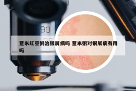 薏米红豆粥治银屑病吗 薏米粥对银屑病有用吗