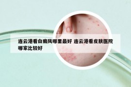 连云港看白癜风哪里最好 连云港看皮肤医院哪家比较好