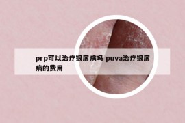 prp可以治疗银屑病吗 puva治疗银屑病的费用