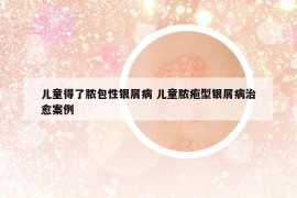 儿童得了脓包性银屑病 儿童脓疱型银屑病治愈案例