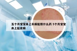 五个月宝宝身上长癣能擦什么药 5个月宝宝身上起皮癣