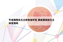 牛皮癣擦白凡士林有啥坏处 银屑病涂抹凡士林管用吗