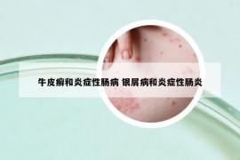 牛皮癣和炎症性肠病 银屑病和炎症性肠炎