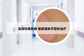 关结性银屑病 银屑病关节型的治疗