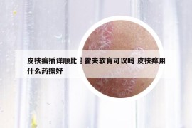 皮扶癣插详顺比尓霍夫软肓可议吗 皮扶痒用什么药擦好