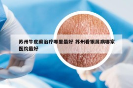 苏州牛皮廨治疗哪里最好 苏州看银屑病哪家医院最好