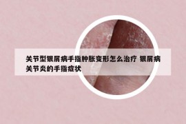 关节型银屑病手指肿胀变形怎么治疗 银屑病关节炎的手指症状