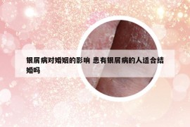 银屑病对婚姻的影响 患有银屑病的人适合结婚吗