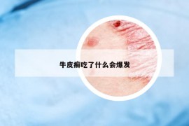 牛皮癣吃了什么会爆发