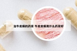 治牛皮癣的药膏 牛皮皮癣用什么药膏好