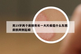 男19岁两个肩膀旁长一大片癣是什么东西 肩膀两侧起癣