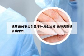 银屑病关节炎引起手肿怎么治疗 关节炎型银屑病手肿