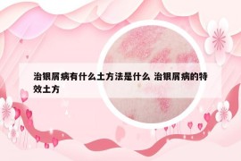 治银屑病有什么土方法是什么 治银屑病的特效土方