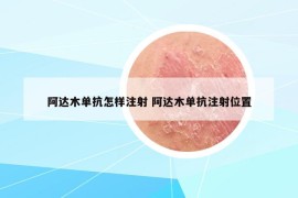 阿达木单抗怎样注射 阿达木单抗注射位置