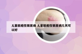 儿童脓疱性银屑病 儿童脓疱性银屑病几天可以好