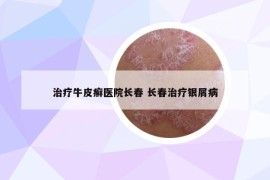 治疗牛皮癣医院长春 长春治疗银屑病