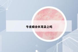 牛皮癣会长耳朵上吗