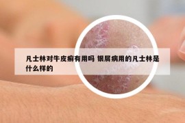 凡士林对牛皮癣有用吗 银屑病用的凡士林是什么样的