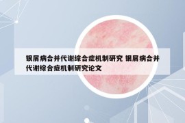 银屑病合并代谢综合症机制研究 银屑病合并代谢综合症机制研究论文