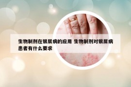 生物制剂在银屑病的应用 生物制剂对银屑病患者有什么要求