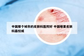 中国那个城市的皮肤科医院好 中国哪里皮肤科最权威