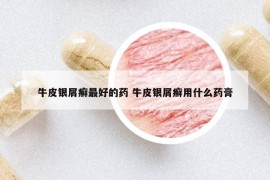 牛皮银屑癣最好的药 牛皮银屑癣用什么药膏