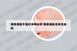 银屑病是不是的多喝水啊 银屑病应该多洗澡吗