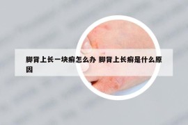 脚背上长一块癣怎么办 脚背上长癣是什么原因