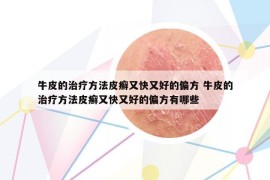 牛皮的治疗方法皮癣又快又好的偏方 牛皮的治疗方法皮癣又快又好的偏方有哪些