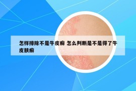 怎样排除不是牛皮癣 怎么判断是不是得了牛皮肤癣