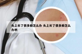 头上长了很多癣怎么办 头上长了很多癣怎么办啊