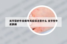 关节型的牛皮癣冬天应该注意什么 关节性牛皮肤癣