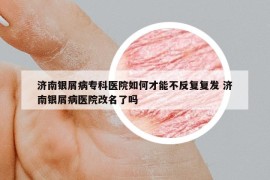 济南银屑病专科医院如何才能不反复复发 济南银屑病医院改名了吗