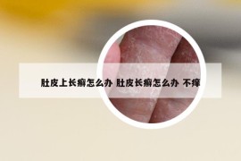 肚皮上长癣怎么办 肚皮长癣怎么办 不痒