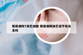 银屑病和T淋巴细胞 银屑病跟淋巴结节有关系吗