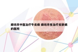 廊坊市中医治疗牛皮癣 廊坊市有治疗皮肤病的医院