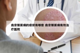 南京银屑病的症状有哪些 南京银屑病有效治疗医院