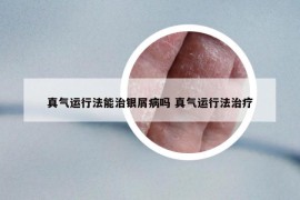 真气运行法能治银屑病吗 真气运行法治疗