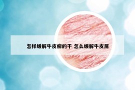 怎样缓解牛皮癣的干 怎么缓解牛皮屑