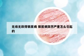 无缘无故得银屑病 银屑病突然严重怎么引起的