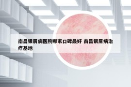 南昌银屑病医院哪家口碑最好 南昌银屑病治疗基地