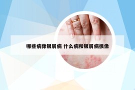 哪些病像银屑病 什么病和银屑病很像