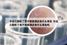 卡泊三醇除了用于银屑病还有什么用处 卡泊三醇除了用于银屑病还有什么用处吗