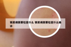 银屑病需要检查什么 银屑病需要检查什么确诊