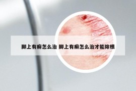 脚上有癣怎么治 脚上有癣怎么治才能除根