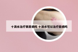 十滴水治疗银屑病吗 十滴水可以治疗藓病吗