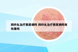 四妙丸治疗银屑病吗 四妙丸治疗银屑病吗有效果吗