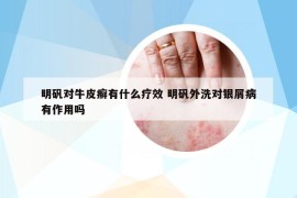 明矾对牛皮癣有什么疗效 明矾外洗对银屑病有作用吗